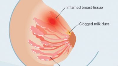 Tips Melancarkan Asi Tersumbat bagi Ibu Menyusui